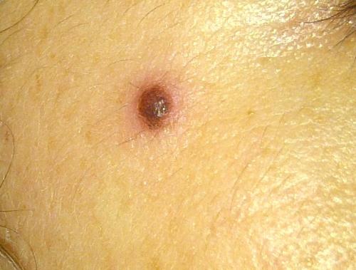 После прыща образовалась родинка. Прыщ на родинке