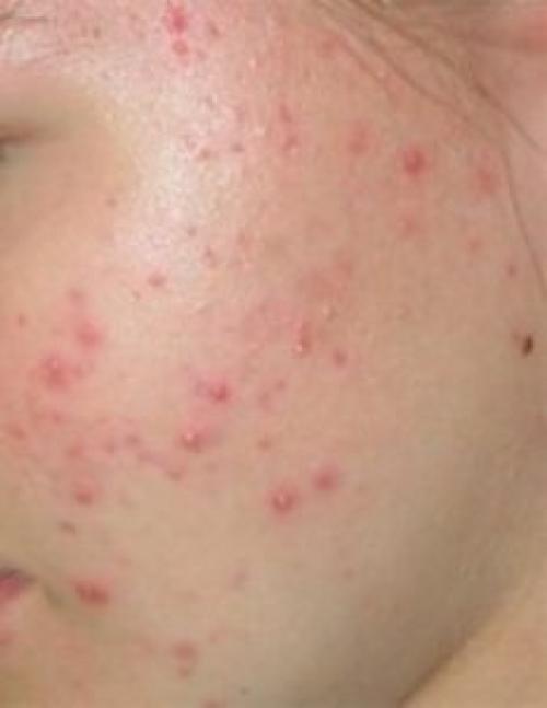 Гинекология и прыщи на лице. Что такое гормональная угревая сыпь