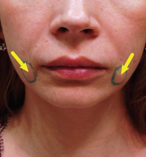 Осложнения подтяжки лица и ее прогноз. Возможные осложнения после подтяжки кожи лица 05 Осложнения подтяжки лица и ее прогноз. Возможные осложнения после подтяжки кожи лица 05