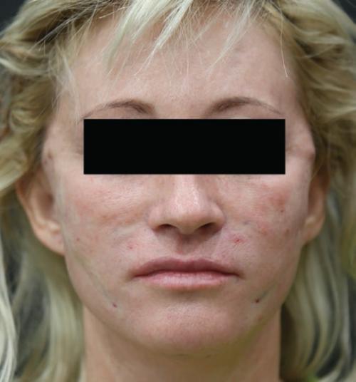 Осложнения подтяжки лица и ее прогноз. Возможные осложнения после подтяжки кожи лица 04 Осложнения подтяжки лица и ее прогноз. Возможные осложнения после подтяжки кожи лица 04