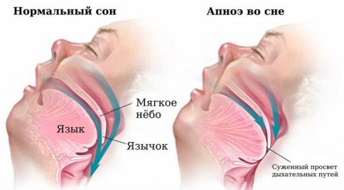Часто просыпаюсь по ночам и не могу уснуть. Сложности с пробуждением, как признак бессонницы 02