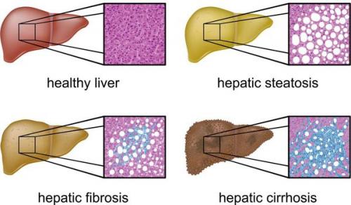 Функции печени в нормализации избыточного веса. Фосфоглив® при жировом гепатозе 02