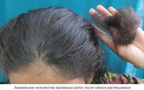 Как избежать выпадения волос. Причины выпадения волос 02 Как избежать выпадения волос. Причины выпадения волос 02