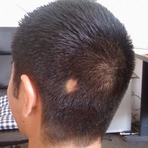 Почему молодое поколение сталкивается с облысением? Причины и решения 08