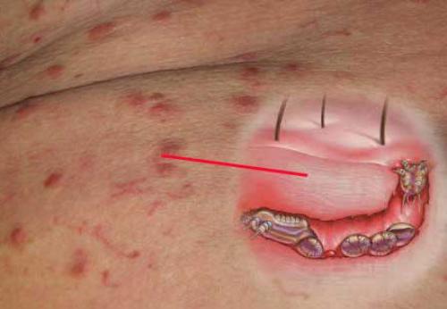 Зуд на спине в одном месте. Причины, почему спина чешется и методы лечения зуда в области лопаток