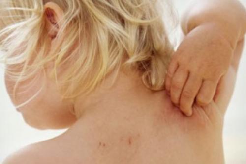 Зуд на спине в одном месте. Причины, почему спина чешется и методы лечения зуда в области лопаток