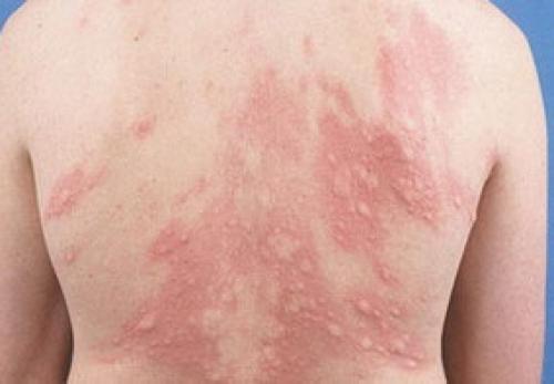 Зуд на спине в одном месте. Причины, почему спина чешется и методы лечения зуда в области лопаток