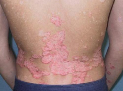 Зуд на спине в одном месте. Причины, почему спина чешется и методы лечения зуда в области лопаток