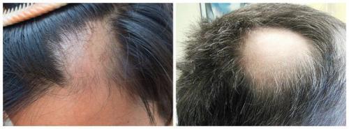 Сильно выпадают волосы у женщины. Каким бывает выпадение волос? 03