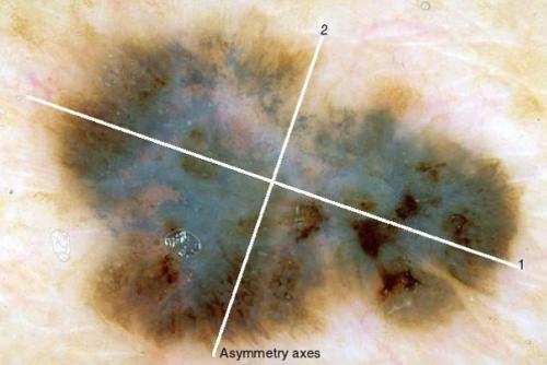 Как отличить родинку от меланомы. Что такое невусы 02