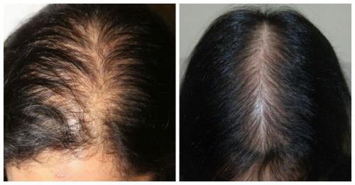 Линия роста волос у женщин. Симптомы выпадения волос 01 Линия роста волос у женщин. Симптомы выпадения волос 01