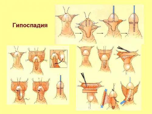 Гипоспадия. Нужно ли лечить гипоспадию?