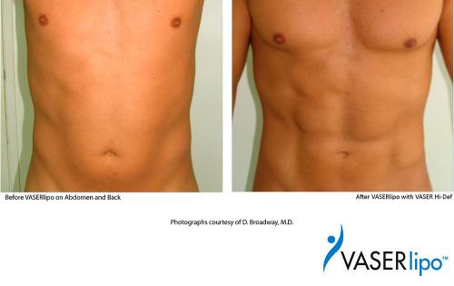 Что такое ультразвуковая липосакция? 03 Что такое ультразвуковая липосакция? 03