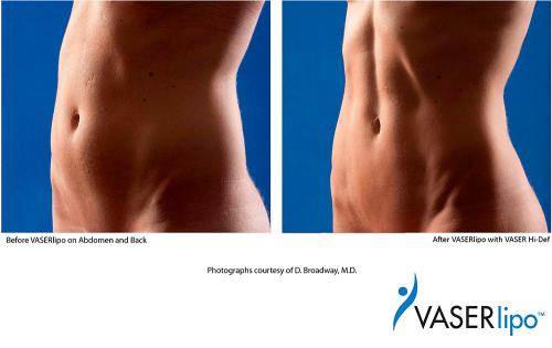 Что такое ультразвуковая липосакция? 02 Что такое ультразвуковая липосакция? 02