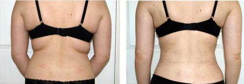 Ультразвуковая липосакция казань. Липосакция Vaser