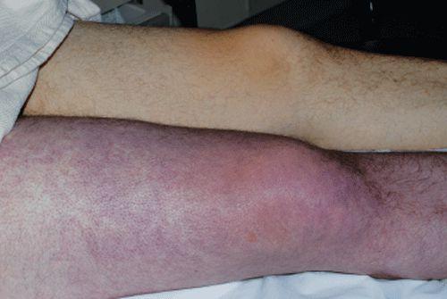 Тромбоз глубоких вен нижних конечностей. Определение болезни. Причины заболевания 04 Тромбоз глубоких вен нижних конечностей. Определение болезни. Причины заболевания 04