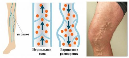 Тромбоз глубоких вен нижних конечностей. Определение болезни. Причины заболевания 02 Тромбоз глубоких вен нижних конечностей. Определение болезни. Причины заболевания 02