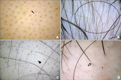 Понимание очаговой алопеции у мужчин: причины, симптомы и лечение 01 Понимание очаговой алопеции у мужчин: причины, симптомы и лечение 01