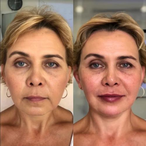 Самые эффективные омолаживающие процедуры для лица. SMAS лифтинг лица