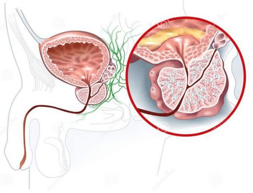 Какие упражнения делать при аденоме простаты. Список упражнений при простатите 05