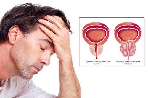 Использование упражнений в лечении аденомы простаты. Причины развития аденомы предстательной железы  04