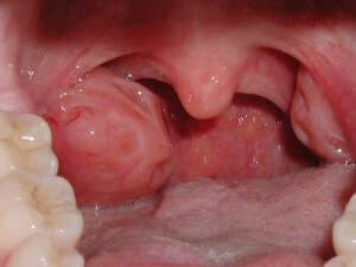Болит горло, больно глотать температуры нет. Причины одностороннего болевого синдрома
