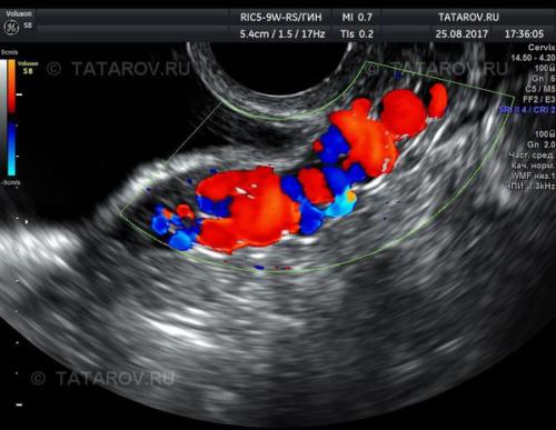 Для улучшения кровообращения в малом тазу. Диагностика варикозного расширения вен таза 01 Для улучшения кровообращения в малом тазу. Диагностика варикозного расширения вен таза 01