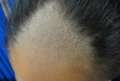 Можно ли остановить выпадение волос после коронавируса. После коронавируса выпадают волосы : что делать? 03 Можно ли остановить выпадение волос после коронавируса. После коронавируса выпадают волосы : что делать? 03