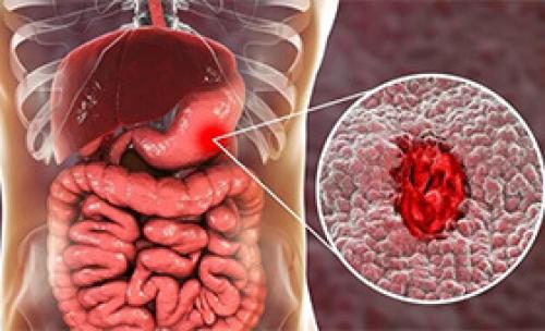 Стресс, как причина заболеваний ЖКТ: последствия и эффективные способы профилактики 05 Стресс, как причина заболеваний ЖКТ: последствия и эффективные способы профилактики 05