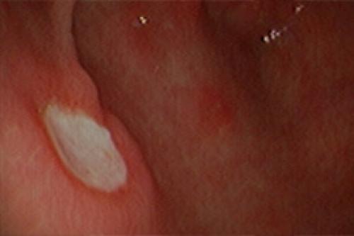 Когда и в каких случаях надо лечить Хеликобактер. Симптомы и диагностика Хеликобактер Пилори 01