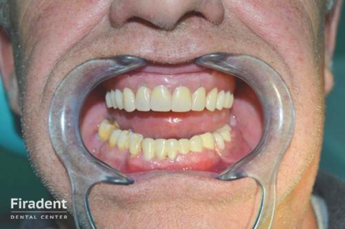 О современных технологиях зубного протезирования. Особенности и преимущества современного протезирования 03