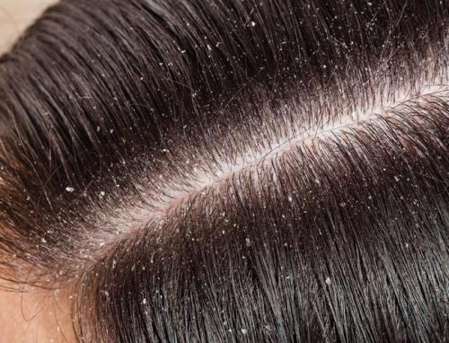 Заболевания волос и кожи головы. Определение болезни. Причины заболевания 01