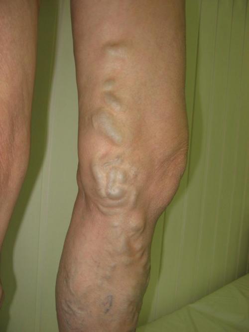 Венозная недостаточность нижних конечностей. ХРОНИЧЕСКАЯ ВЕНОЗНАЯ НЕДОСТАТОЧНОСТЬ — ПРИГОВОР ИЛИ ДИАГНОЗ? 01