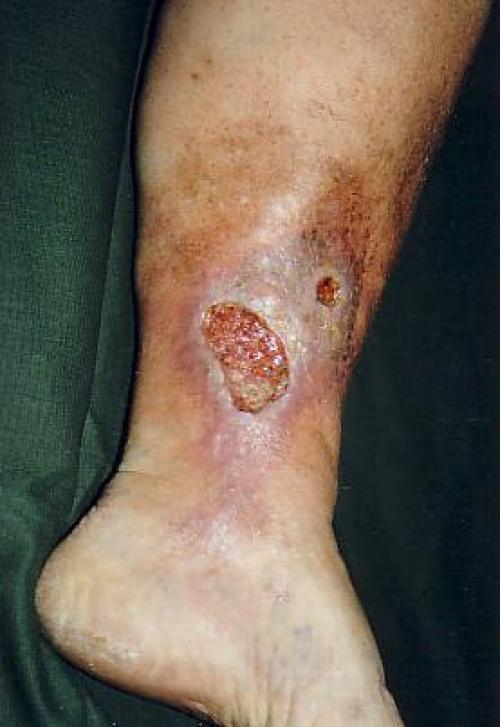 Венозная недостаточность нижних конечностей. ХРОНИЧЕСКАЯ ВЕНОЗНАЯ НЕДОСТАТОЧНОСТЬ — ПРИГОВОР ИЛИ ДИАГНОЗ? 02