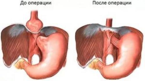 Рефлюкс-эзофагит лечение препараты. Рефлюкс-эзофагит