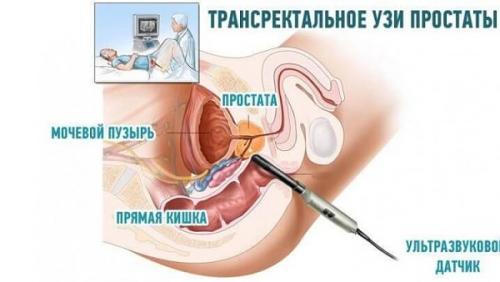 УЗИ малого таза у мужчин, как делают. Что входит в УЗИ органов малого таза у мужчин