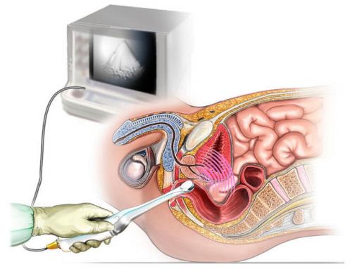 УЗИ органов малого таза у мужчин в подробностях. Основные виды УЗИ, рекомендуемые для комплексного обследования мужчин 01 УЗИ органов малого таза у мужчин в подробностях. Основные виды УЗИ, рекомендуемые для комплексного обследования мужчин 01