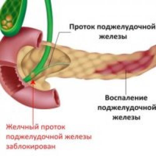Лечение панкреатита. Хронический панкреатит. Причины развития