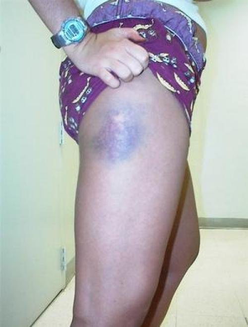 Секреты быстрого избавления от синяков за три дня 01 Секреты быстрого избавления от синяков за три дня 01