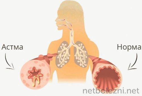 Миф или реальность: почему молодые также подвержены смертельным последствиям коронавируса 02
