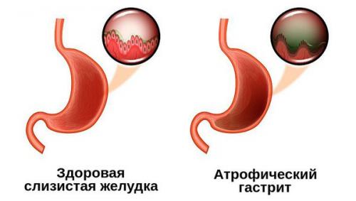 Как восстановить защитные свойства желудка.. 01 Как восстановить защитные свойства желудка.. 01
