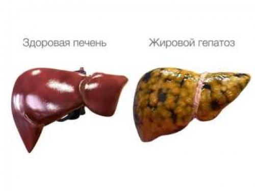 Диета при неалкогольной жировой болезни.. Почему болезнь называют коварной? Нет ни признаков, ни симптомов 04 Диета при неалкогольной жировой болезни.. Почему болезнь называют коварной? Нет ни признаков, ни симптомов 04