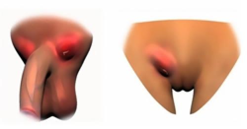 Появление ощутимых болезненных уплотнений. Шишки под кожей 01 Появление ощутимых болезненных уплотнений. Шишки под кожей 01