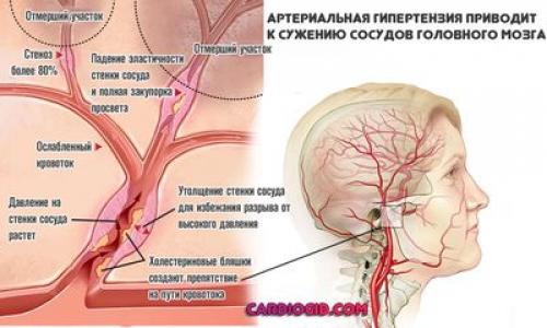 Как лечить сосуды головного мозга и чем. Лечение атеросклероза сосудов головного мозга у взрослых 02 Как лечить сосуды головного мозга и чем. Лечение атеросклероза сосудов головного мозга у взрослых 02