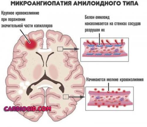 Как лечить сосуды головного мозга и чем. Лечение атеросклероза сосудов головного мозга у взрослых 03 Как лечить сосуды головного мозга и чем. Лечение атеросклероза сосудов головного мозга у взрослых 03