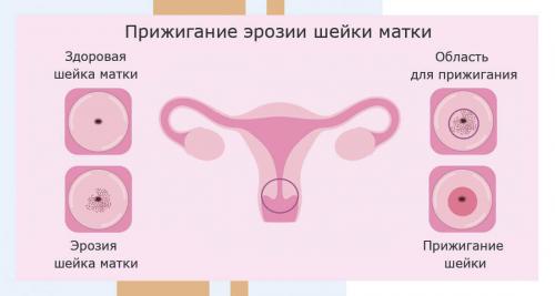Каковы вероятные осложнения при эрозии шейки матки