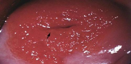 Сколько времени требуется для восстановления после фото прижигания эрозии матки